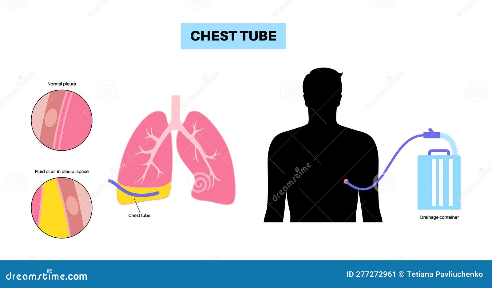 Chest Tube Catheter Stock Vector Illustration Of System 277272961 chest-tube-catheter-stock-vector-illustration-of-thorax-276954299