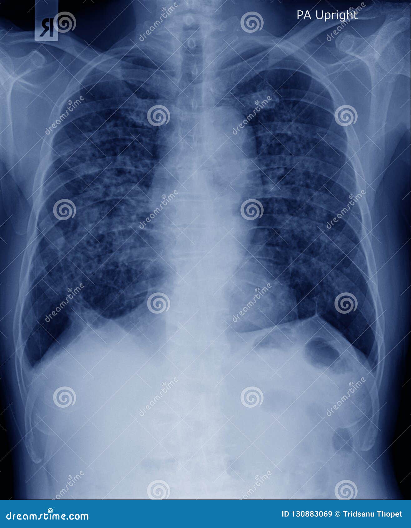 chest x-ray image with secretion