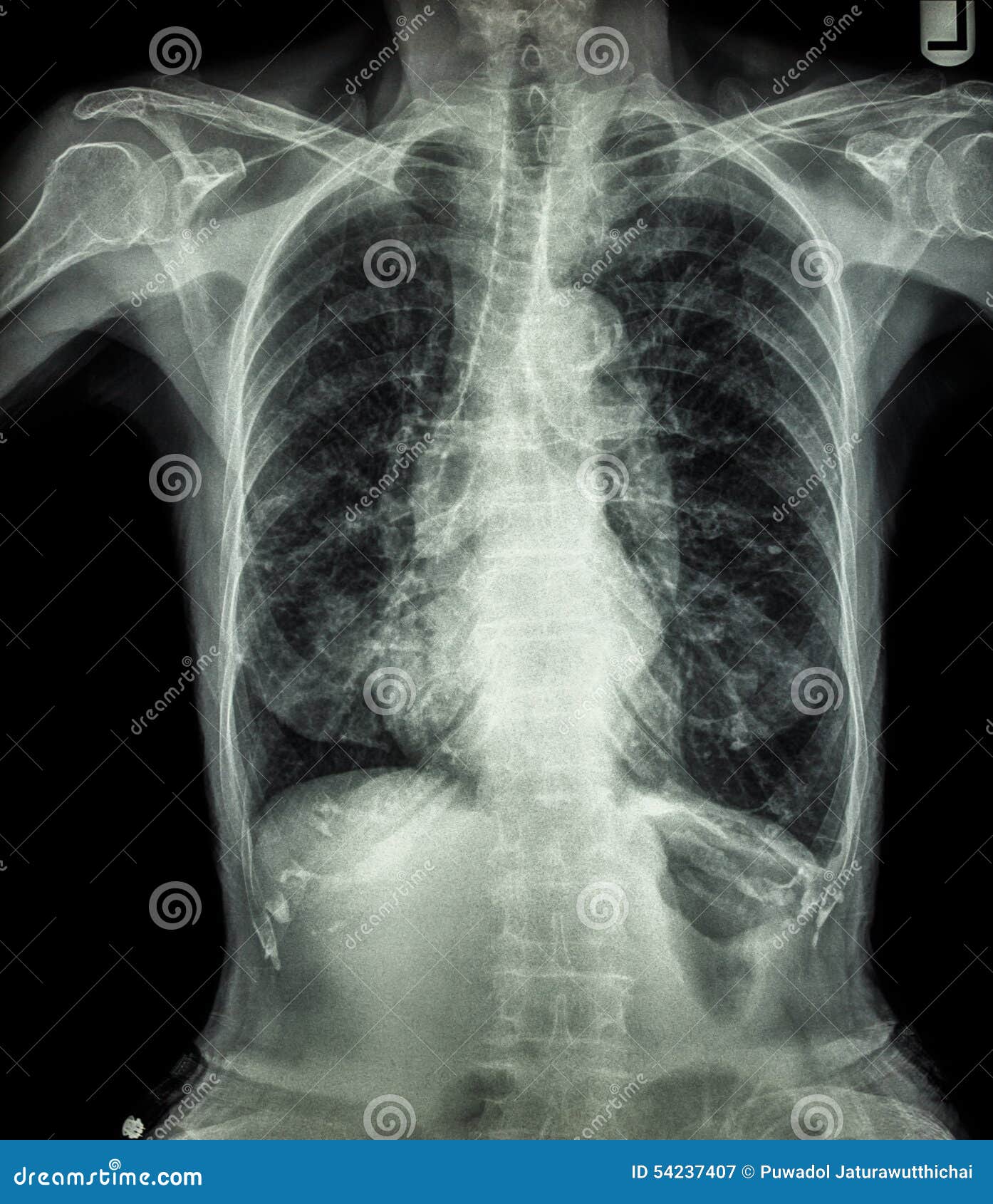 chest x-ray of old patient ( calcification at rib , trachea , bronchus )