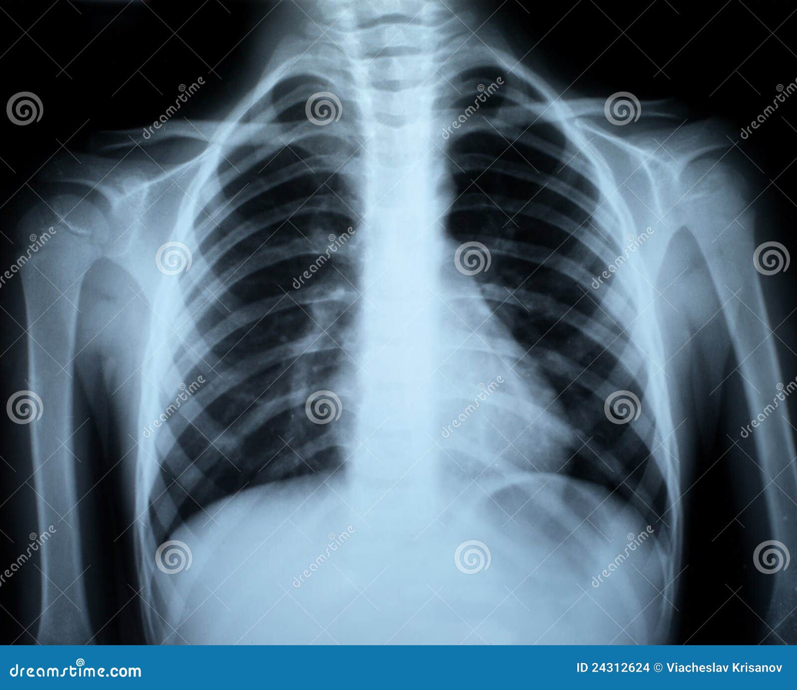 phototime in xray phototime in xray