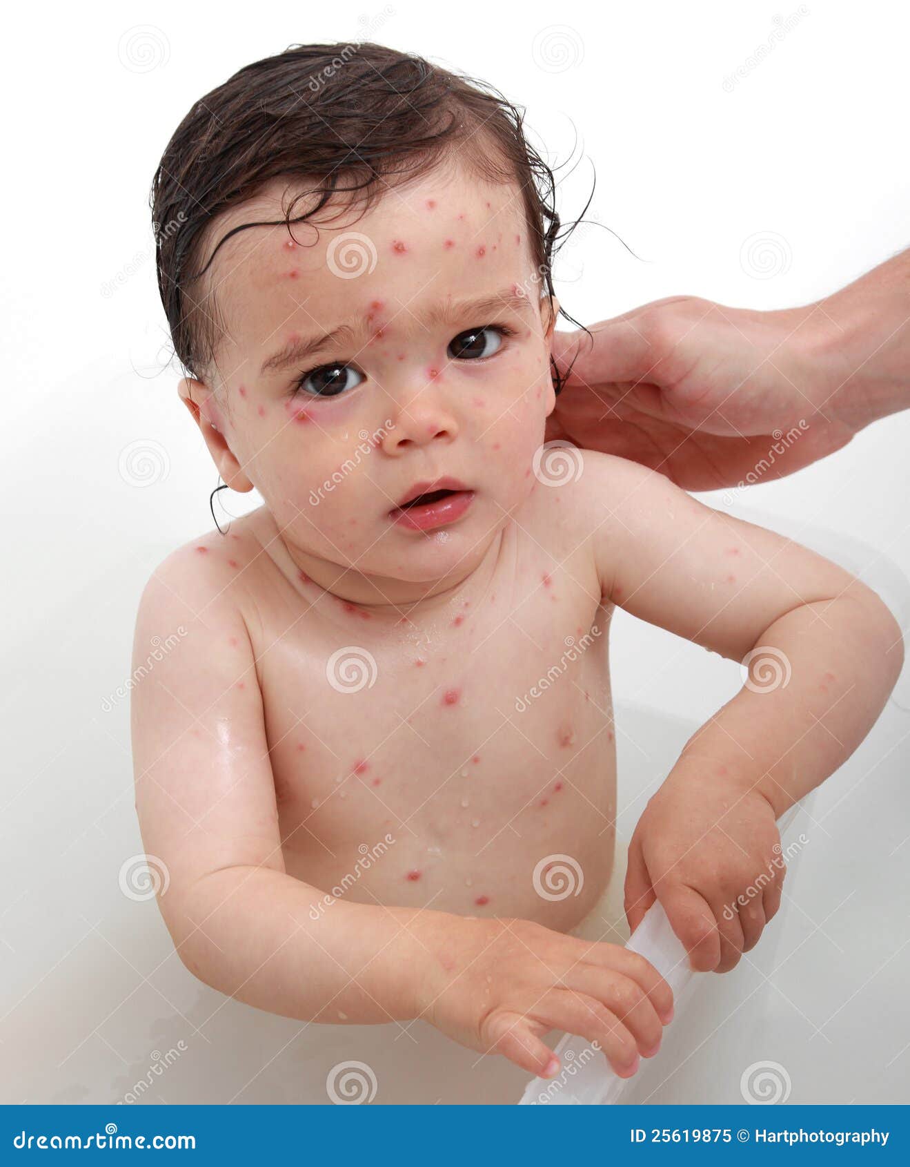 chicken pox