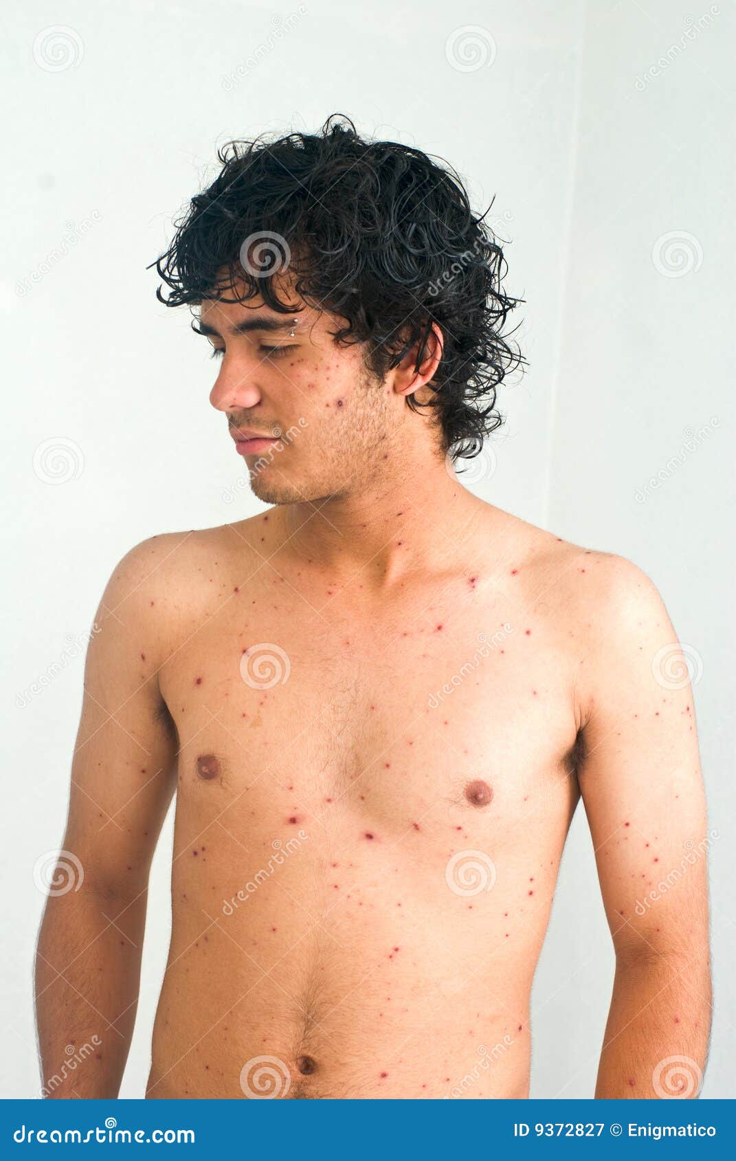 chicken pox boy