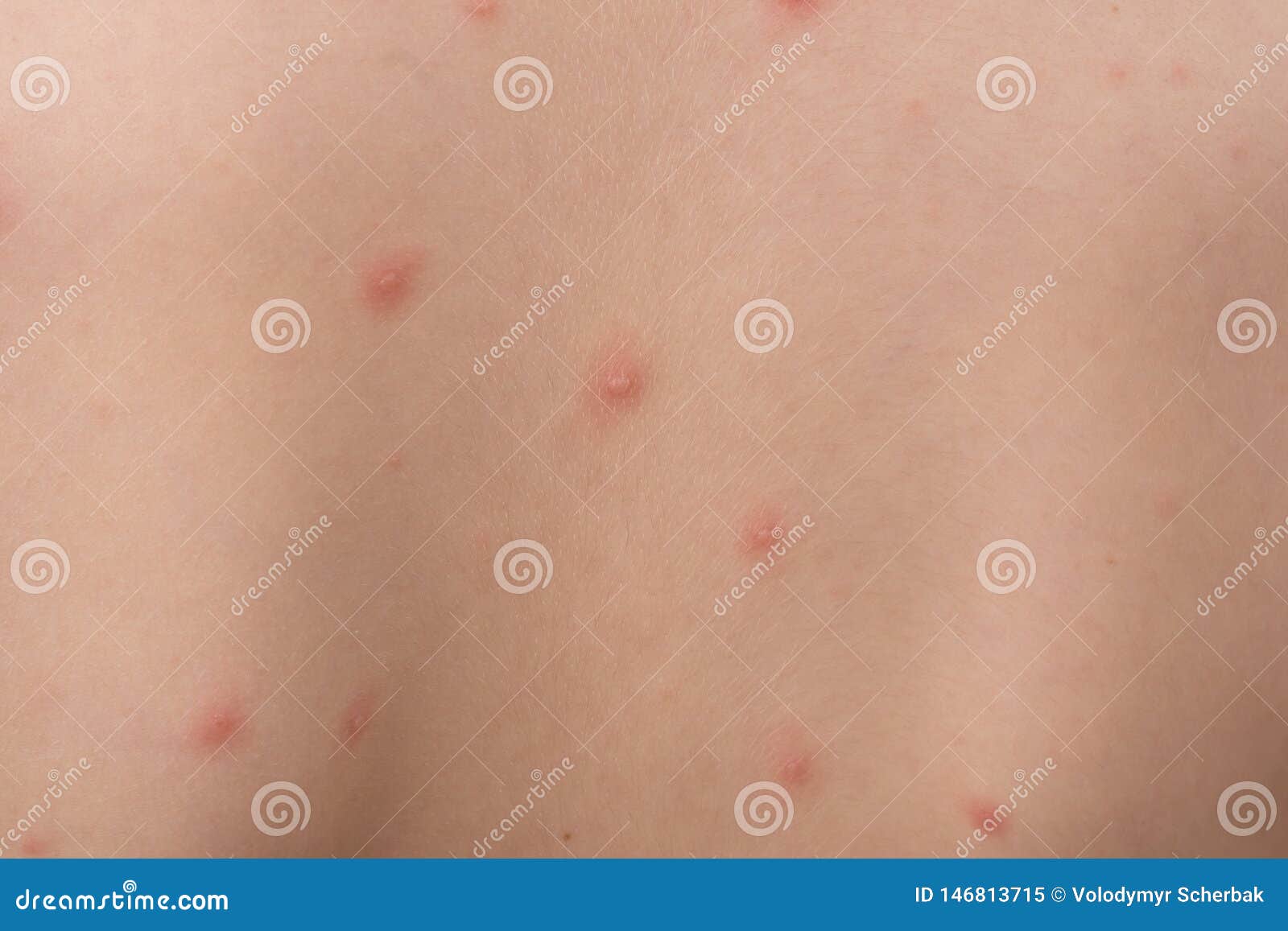 Chicken Pox Rash On Young Boy Body Chickenpox Is An Infection Caused By The Varicella Zoster Virus It Begins As A Blister Like Stock Image Image Of Infection Measles