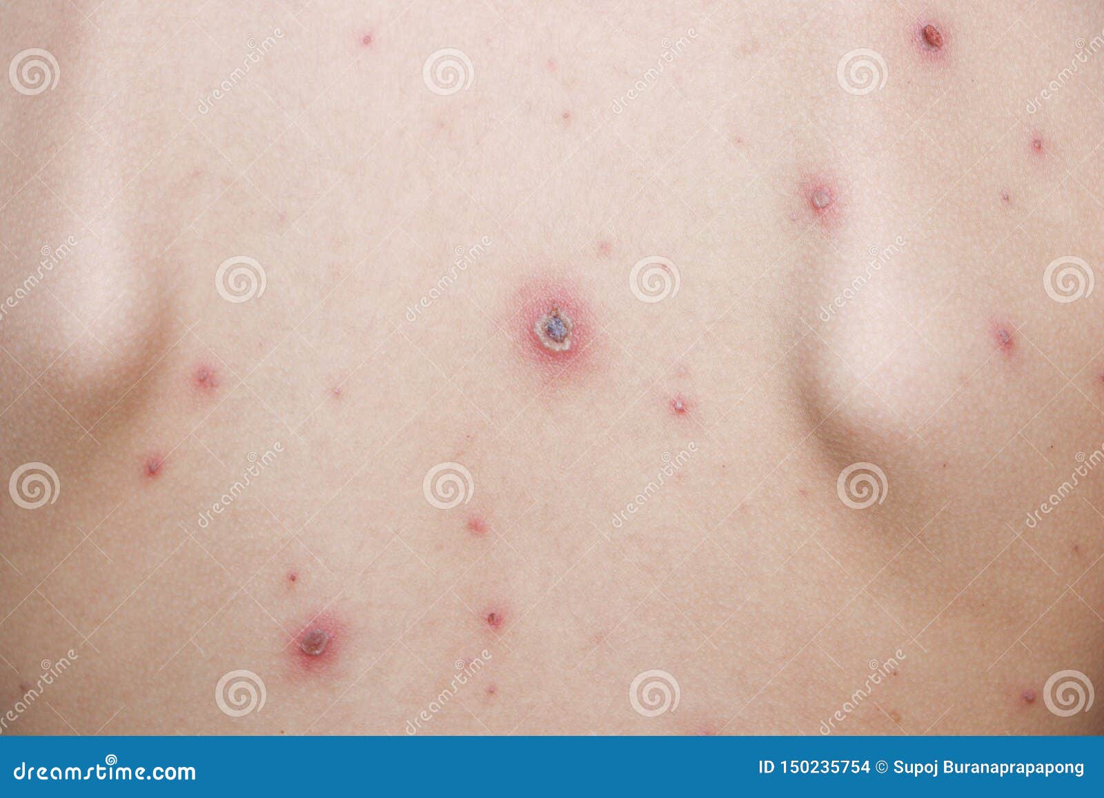 Chicken Pox - NHS, Varicella Zoster Virus, Varicella Chickenpox