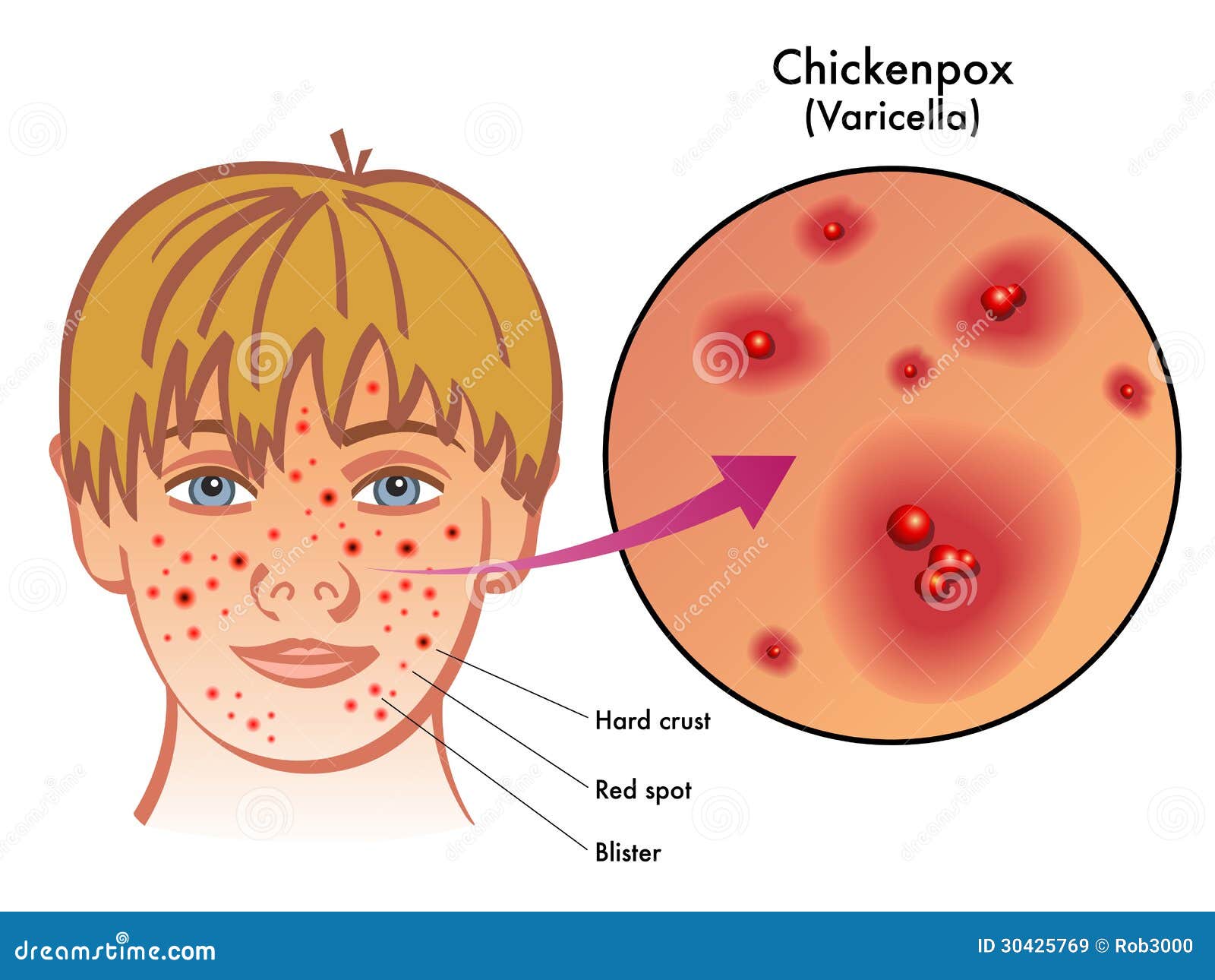 Chickenpox stock vector. Illustration of headache, exanthematous - 30425769