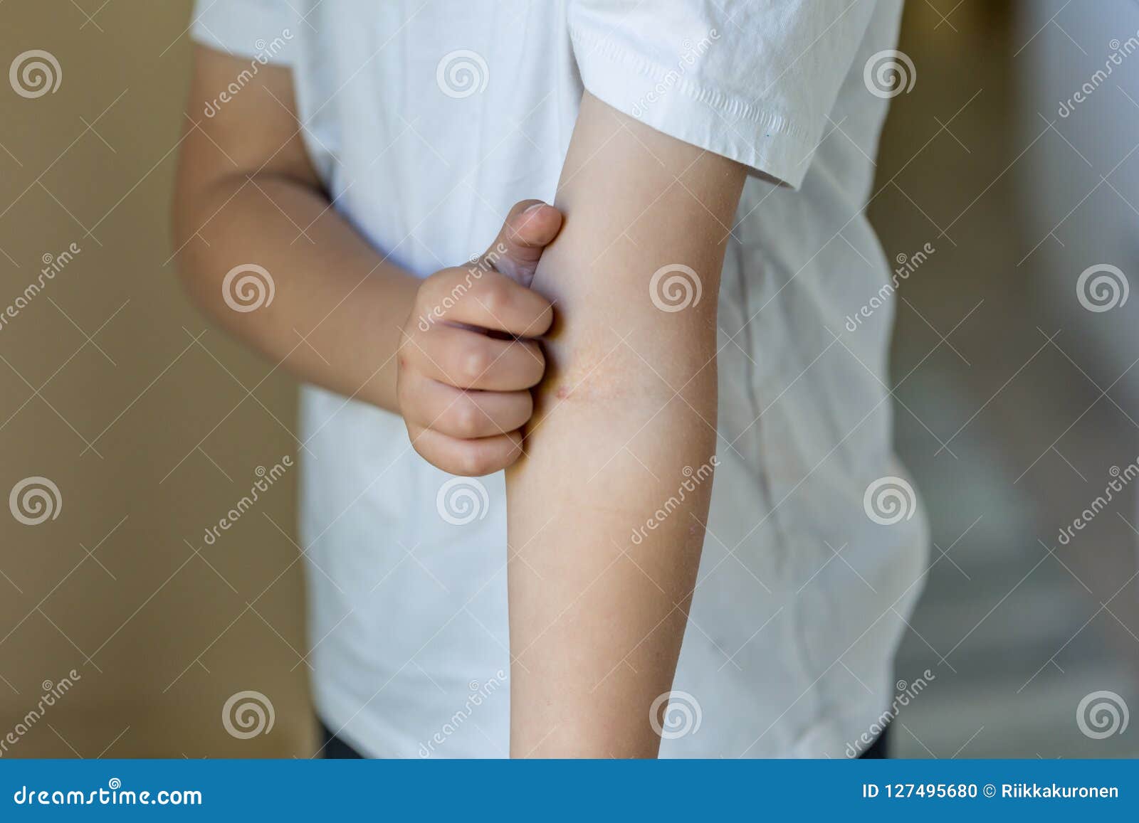 child - boy scratching his arm