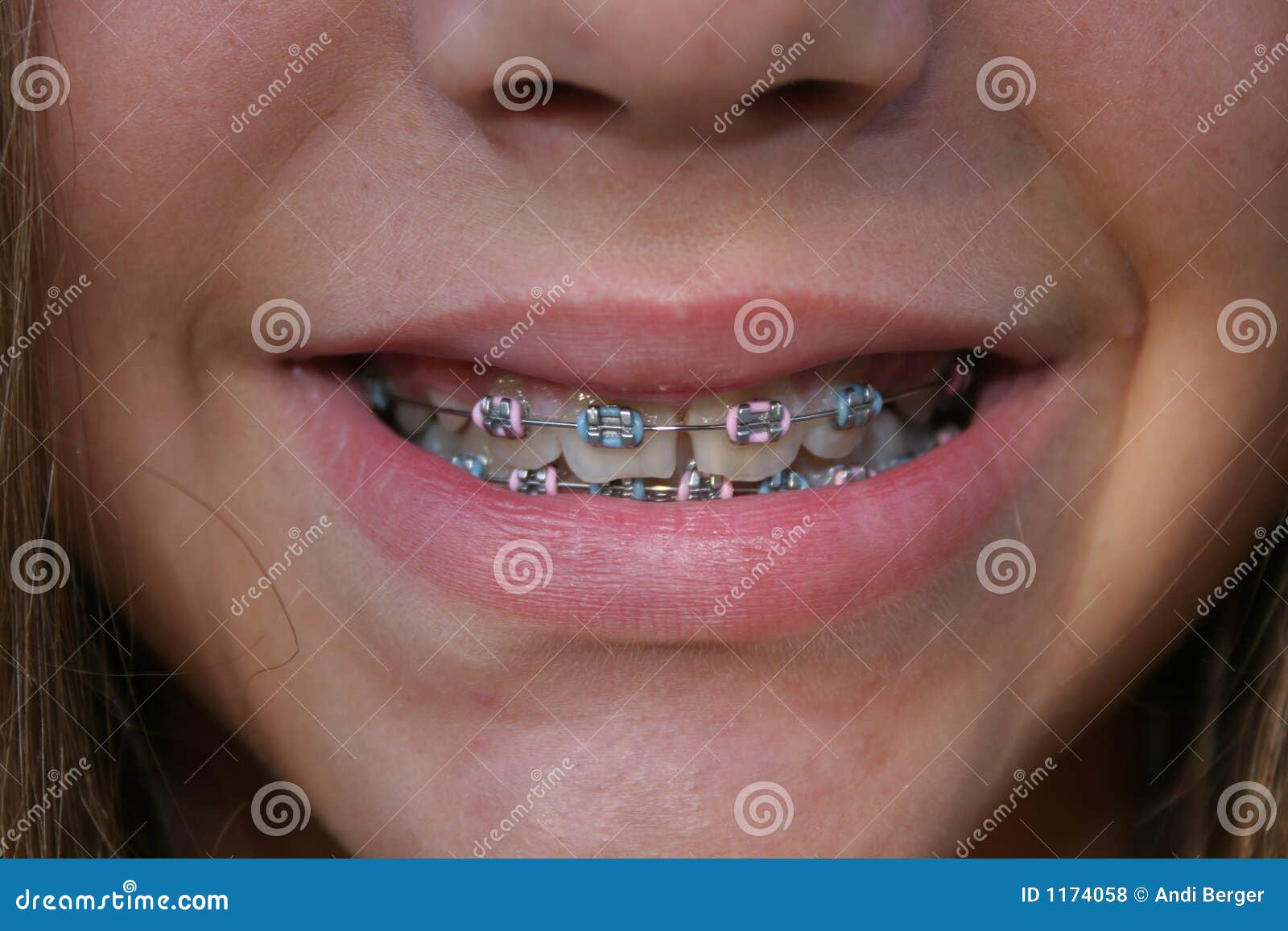 child with braces