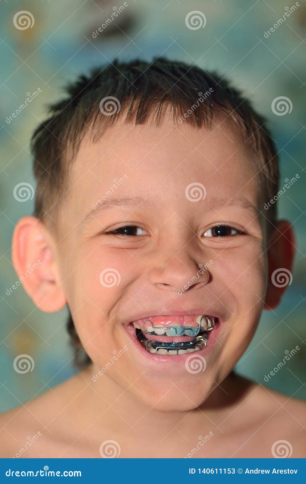 A child with braces smiles stock image. Image of young 140611153