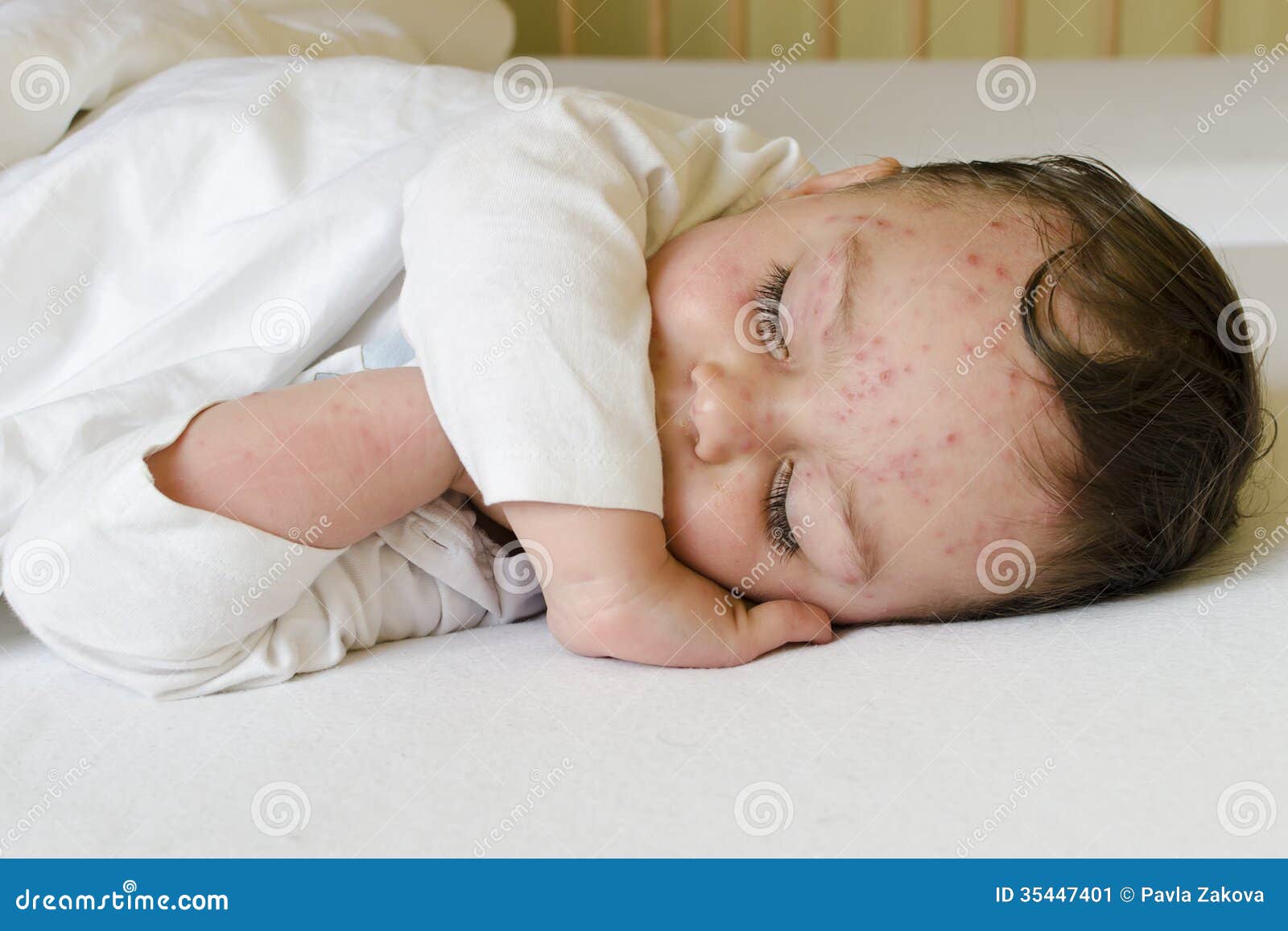 child with chicken pox
