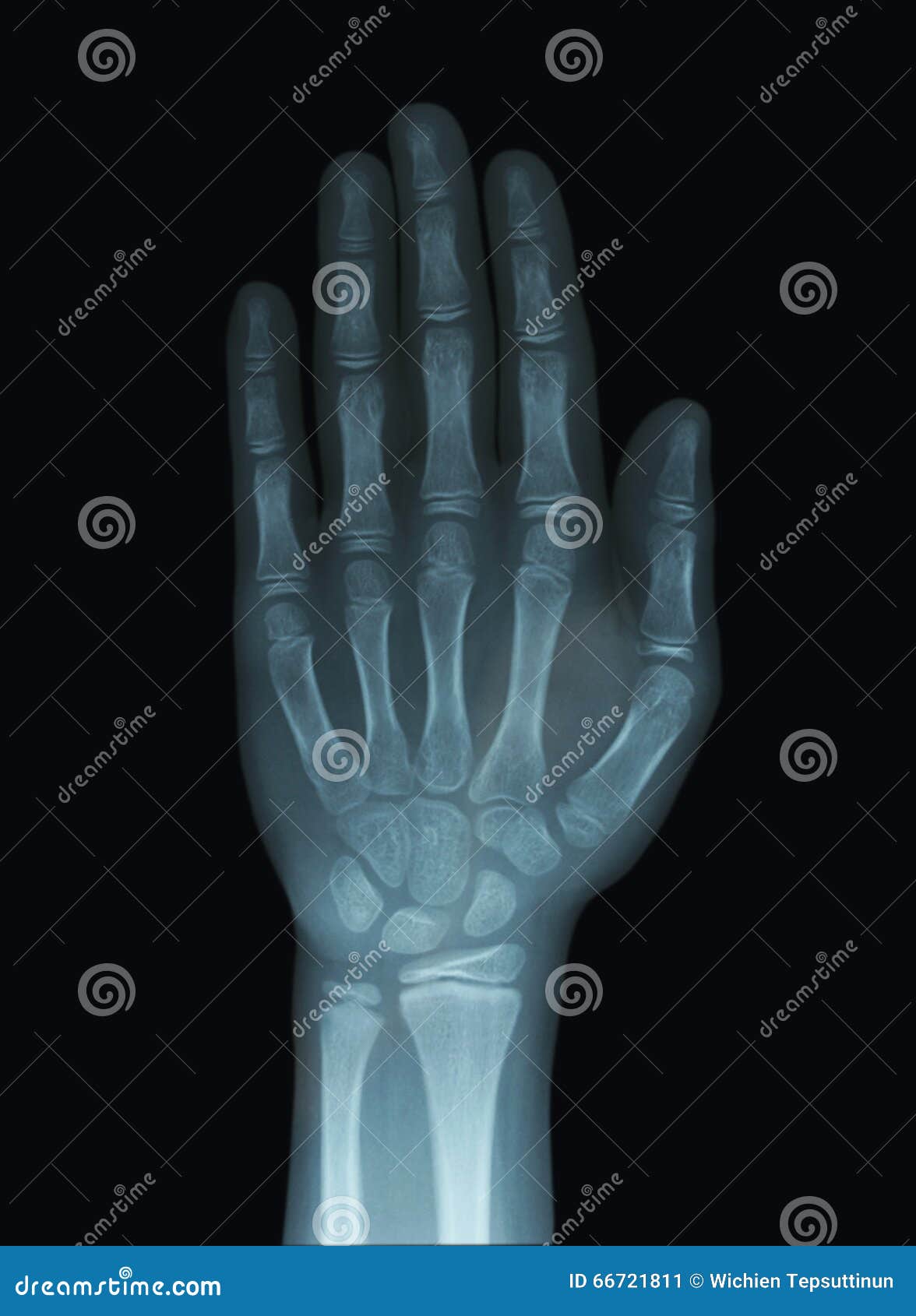 Child Hand XRay Unclosed Epiphysis Stock Image Image of epiphysis, radiology 66721811