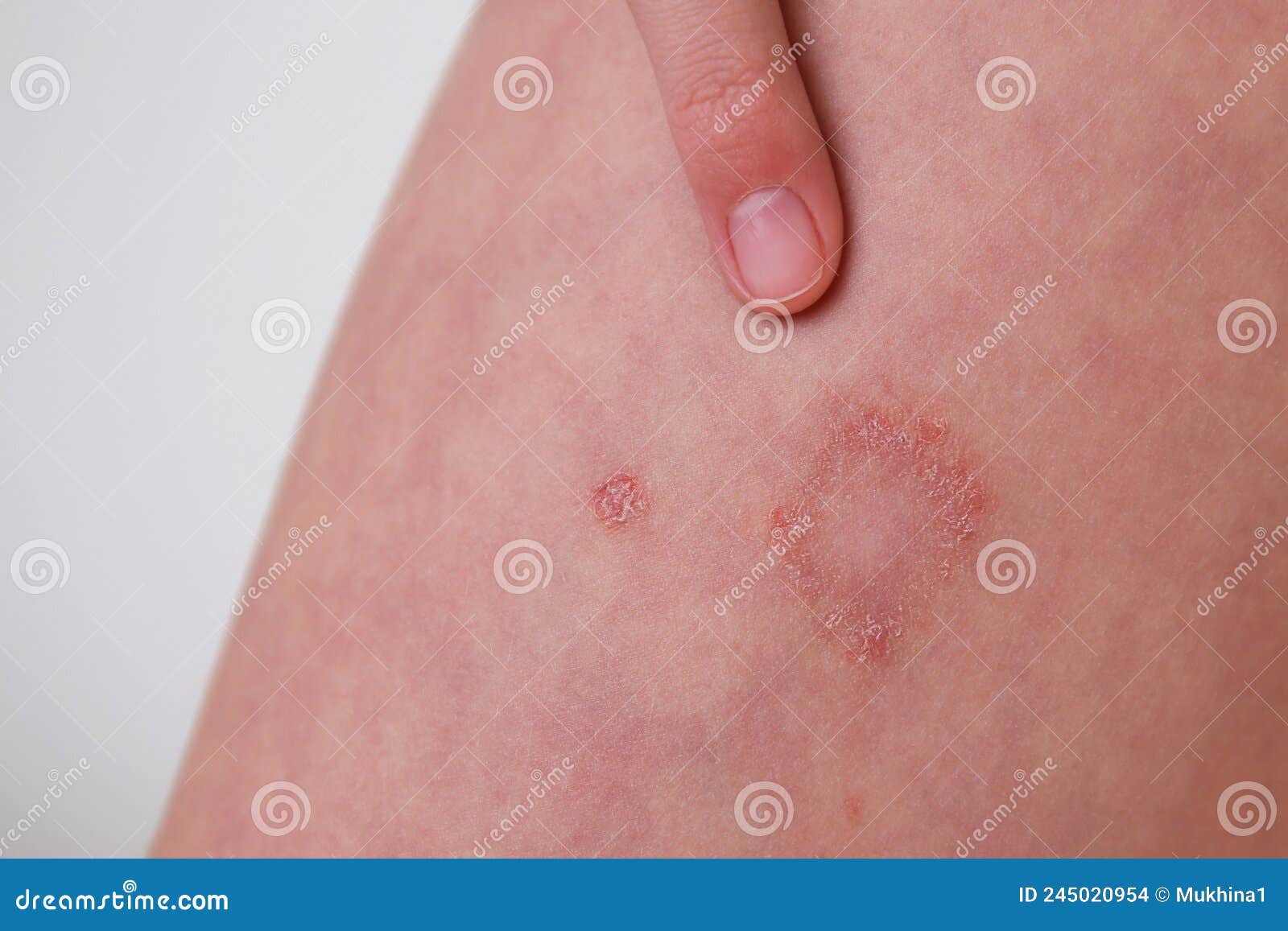 The Child Has Allergic Contact Dermatitis on the Skin Stock Photo Image of caucasian