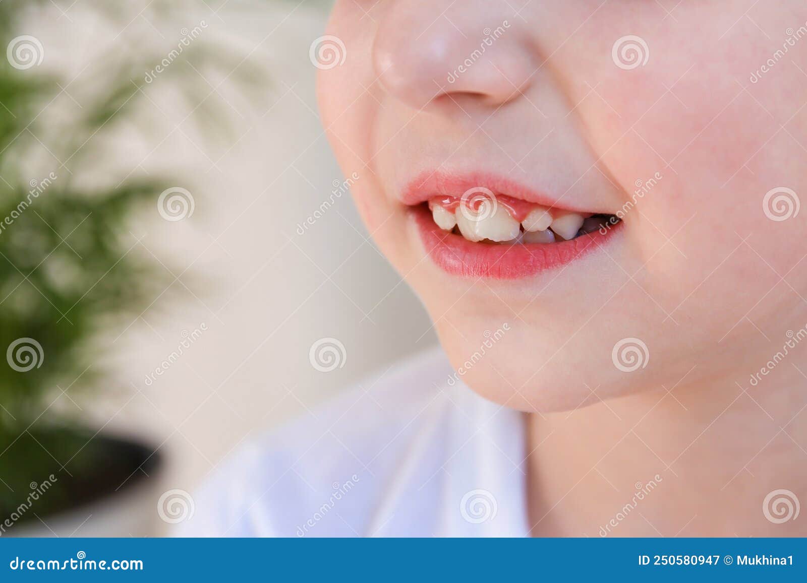 Child Has Crooked Teeth. the Concept of Crowding of Molars Stock Image