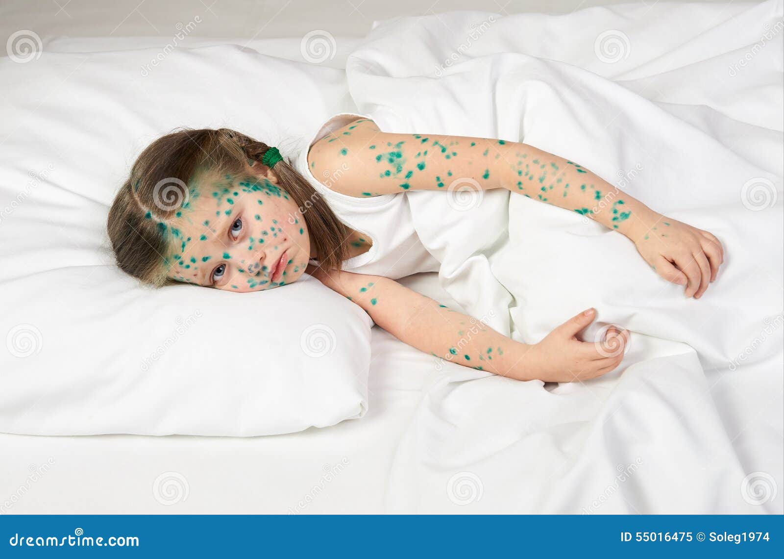 Child Has the Virus on Skin Stock Image Image of brilliant, illness
