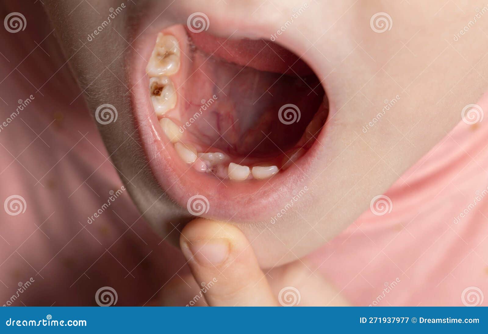 The Child Has a Wrong Tooth. Eruption of a Permanent Tooth in Children