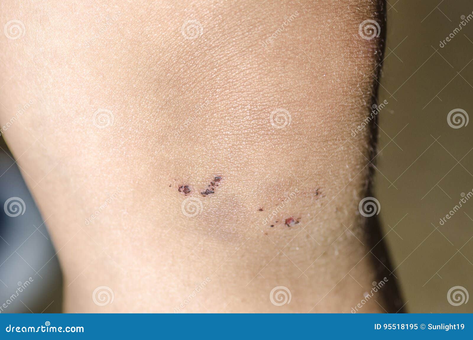 Child Hurt His Knee, an Abrasion on the Pavement Stock Image Image of