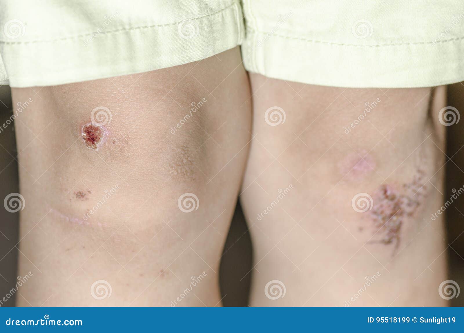 Child Hurt His Knee, an Abrasion on the Pavement Stock Image Image of