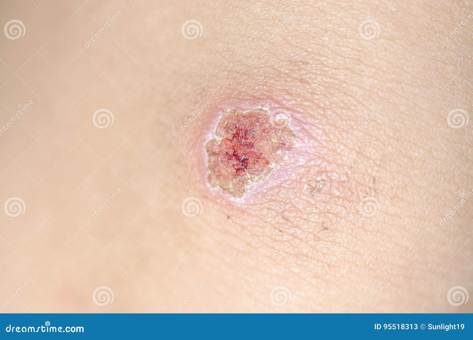 Child Hurt His Knee, an Abrasion on the Pavement Stock Image Image of