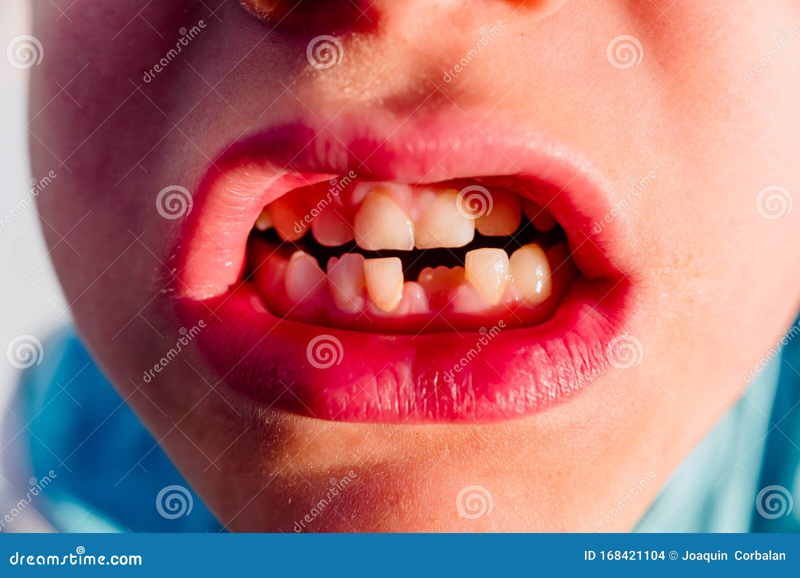 Child Loses His First Milk Tooth Stock Photo - Image of dent, health