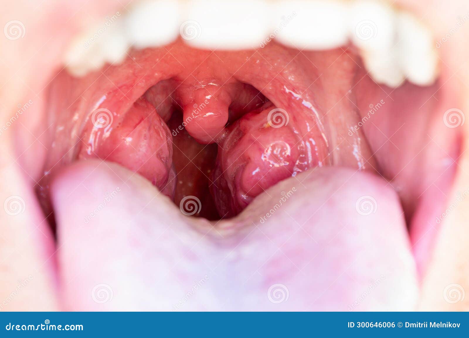 the child is a patient with large red glands. tonsils in close-up in the mouth.