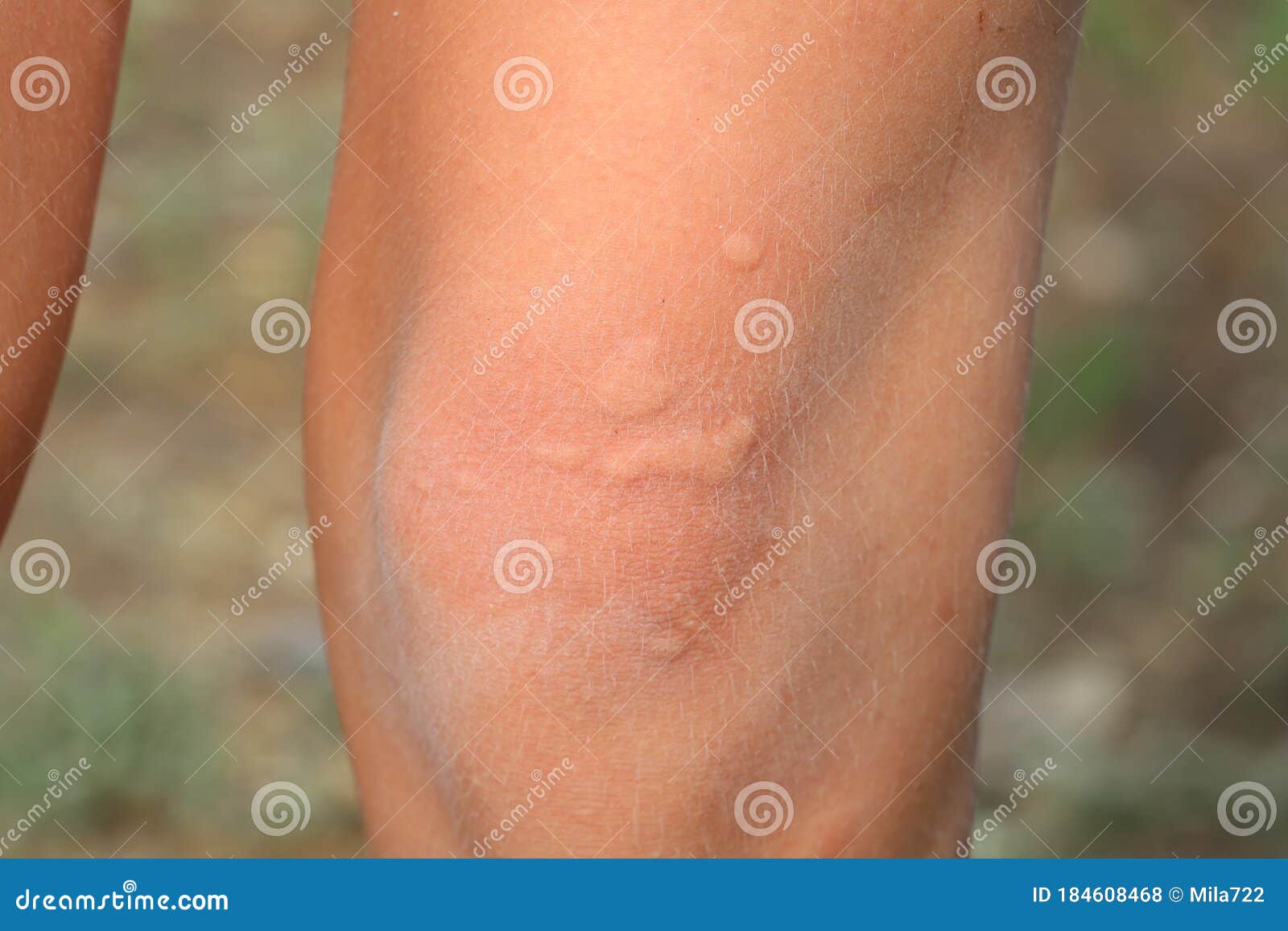 The Child`s Knee Burned with Nettle Grass. Type of Burn Stock Photo