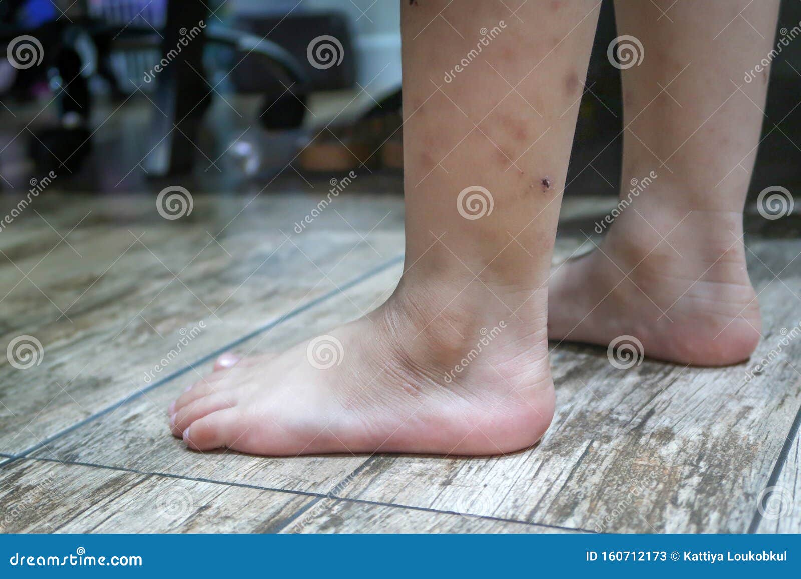 Child`s Leg With Red Spot And Lesion From Mosquito Stock Image Image