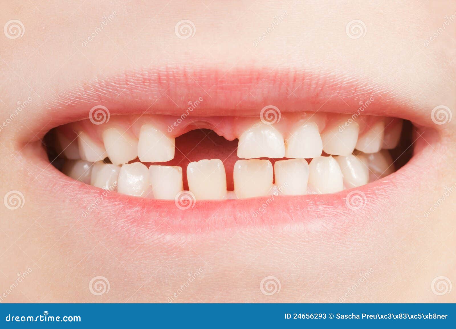 Child with a tooth space stock image. Image of lips, smile 24656293