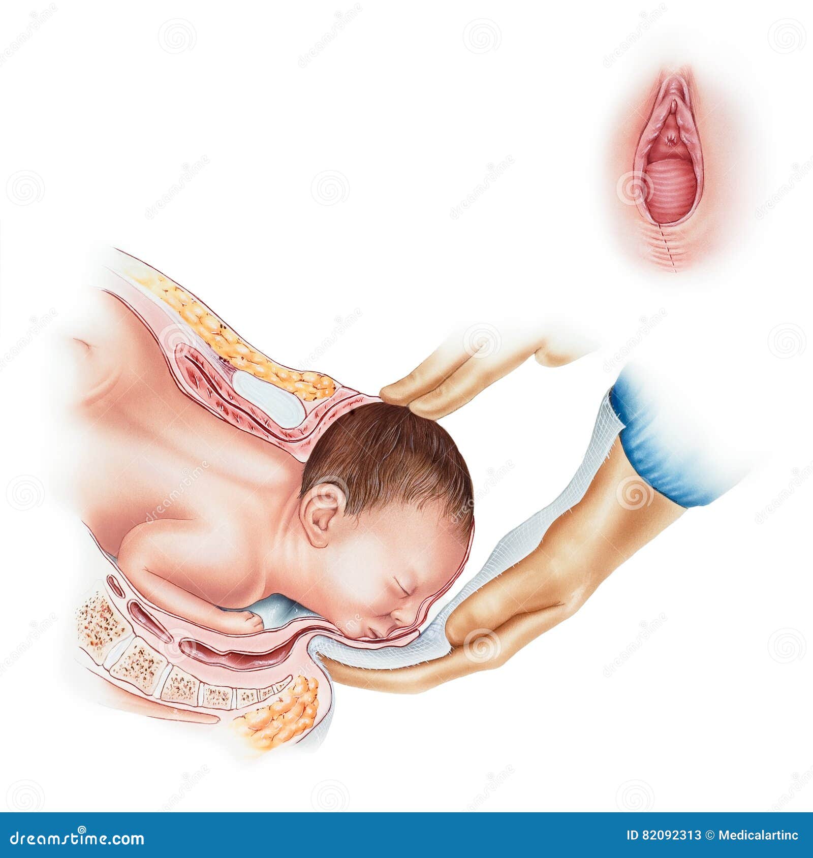 Different types of Diastasis. Diastasis in a woman after pregnancy