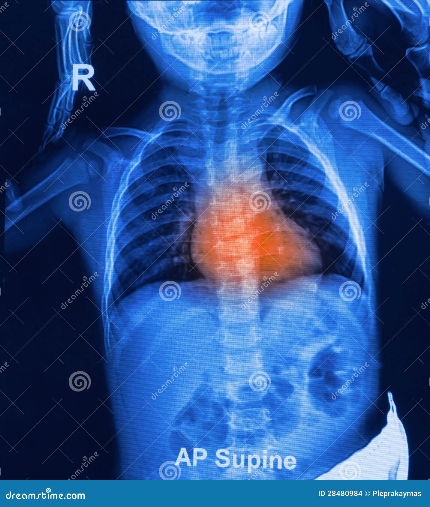 Children chest Xrays stock photo. Image of center, nursery 28480984