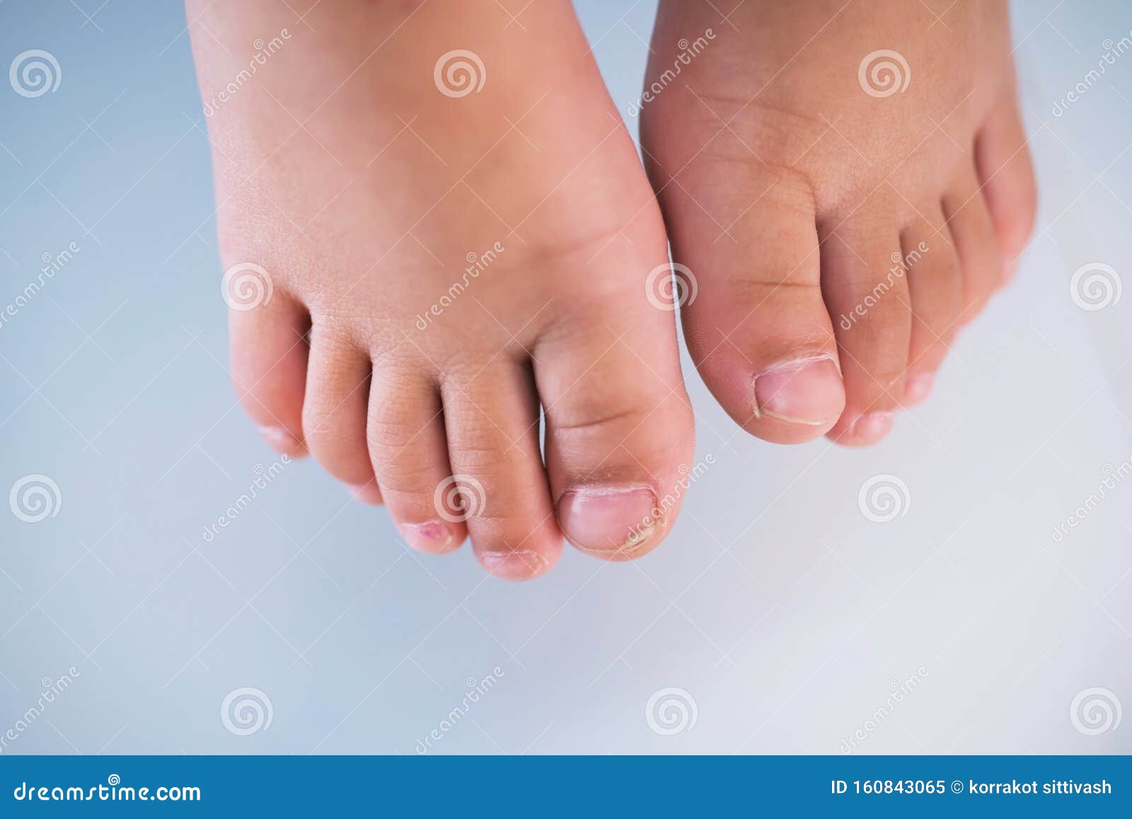 Children Foot with a Cracked and Peeling Toe Nail on the Largest Toe.  Toenail Fungus Stock Image - Image of blue, disease: 160843065