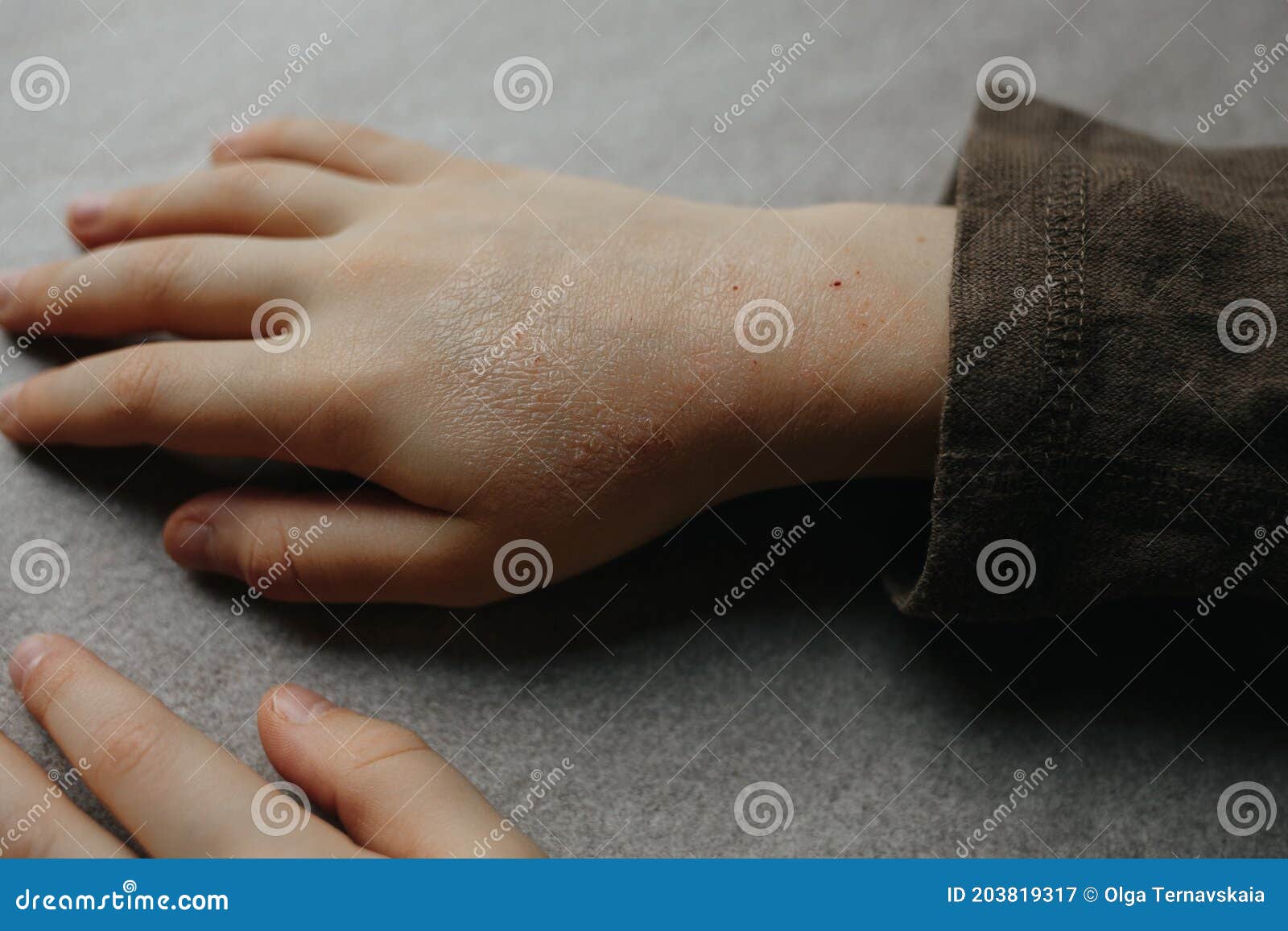 Children Hand With Atopic Dermatitis Eczema On Hand Psoriasis On Kids Hands Stock Image Image Of Allergic Hand Children Hand With Atopic Dermatitis Eczema On Hand Psoriasis On Kids Hands Stock Image Image Of Allergic Hand