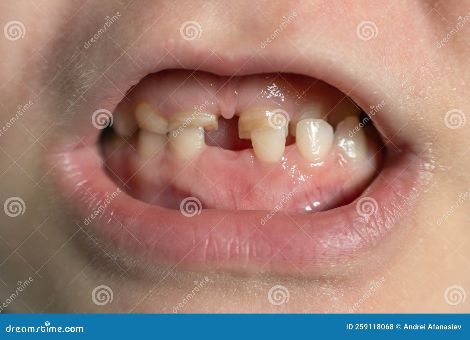 Children`s Mouth with Fallen and Broken Milk Teeth Stock Photo Image