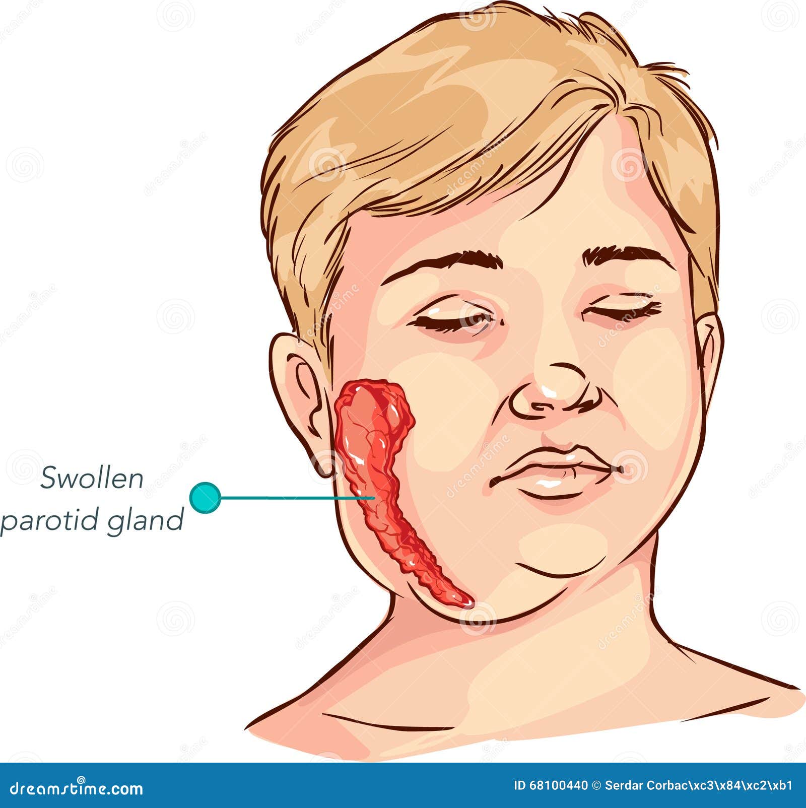 Submandibular Gland Swelling In Children