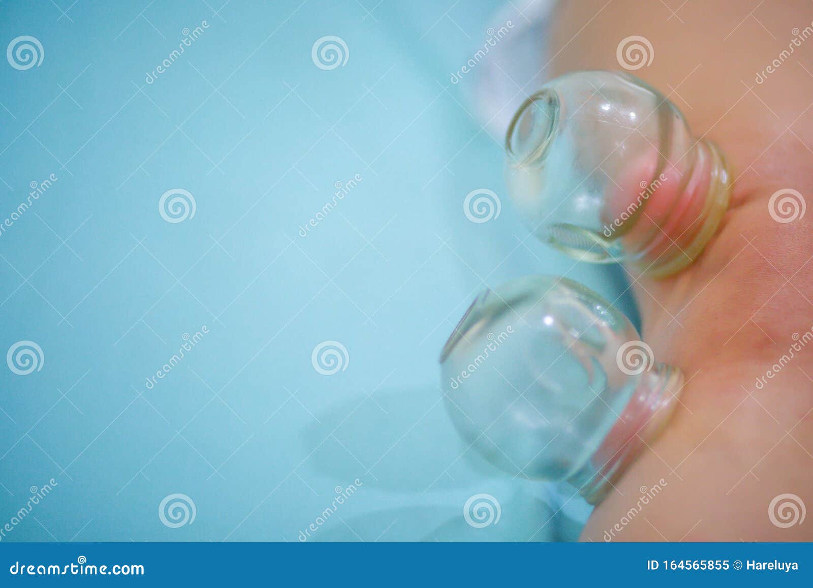 Chinese Medicine Science is a Method of Treatment Using Cupping. Stock