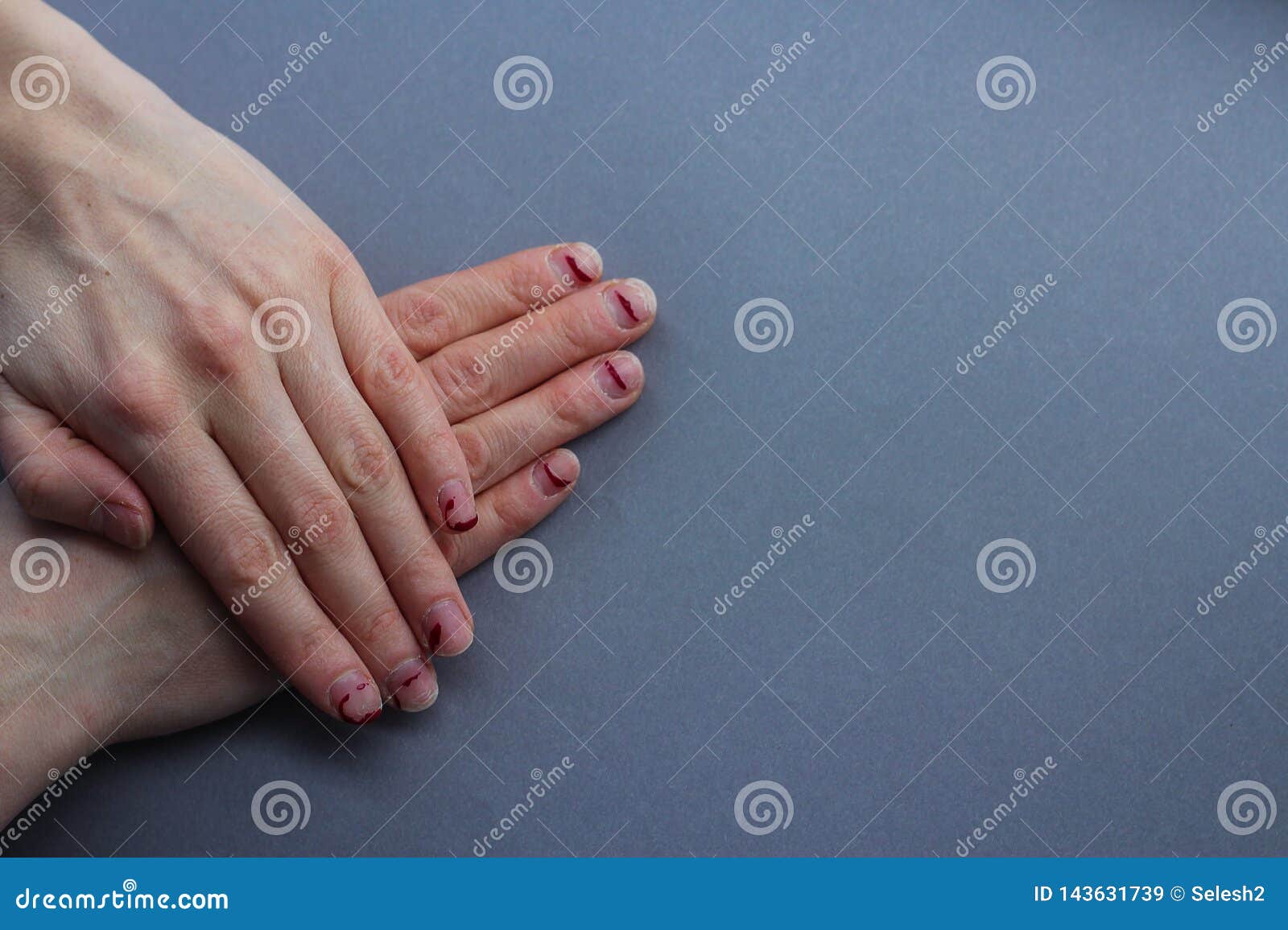 chipped, stratified nails. nails after gel polish. untidy hands on a gray background.the view from the top