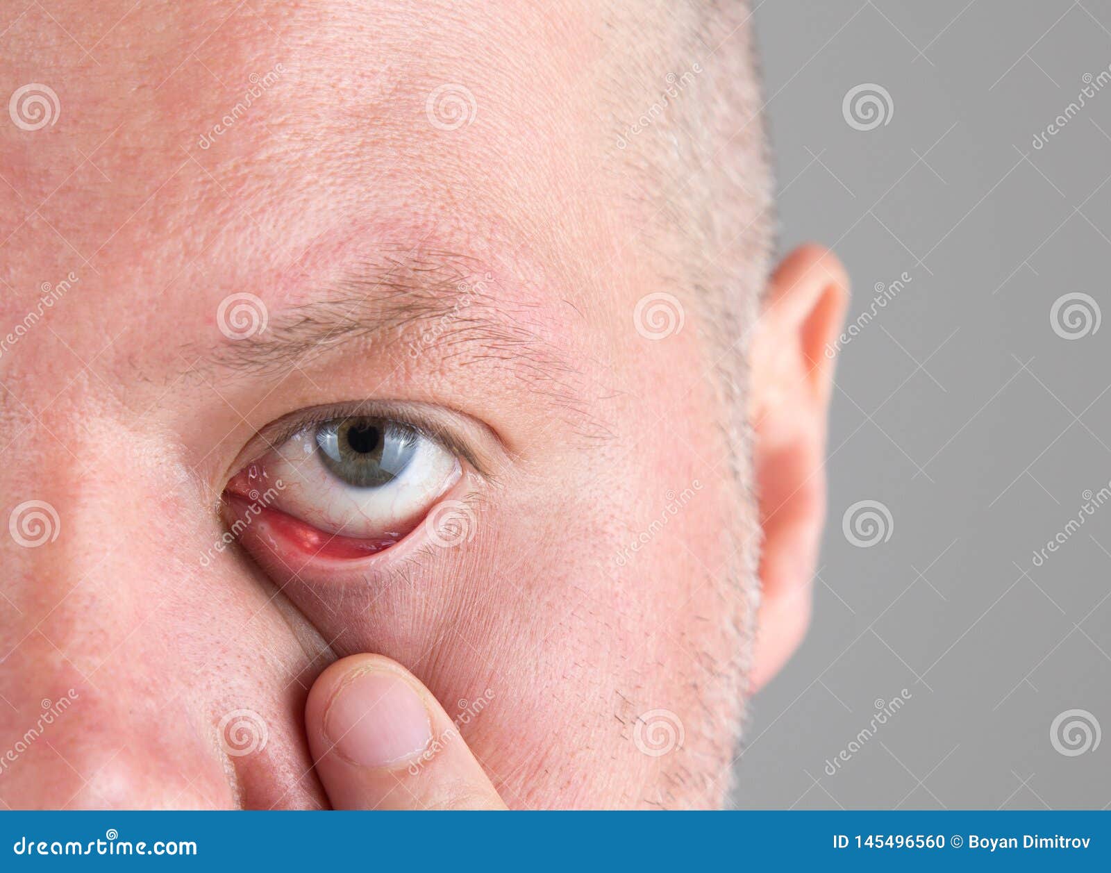 Aproximação de um chiqueiro de olho de homem calázio de doença oftálmica de  hordéolo