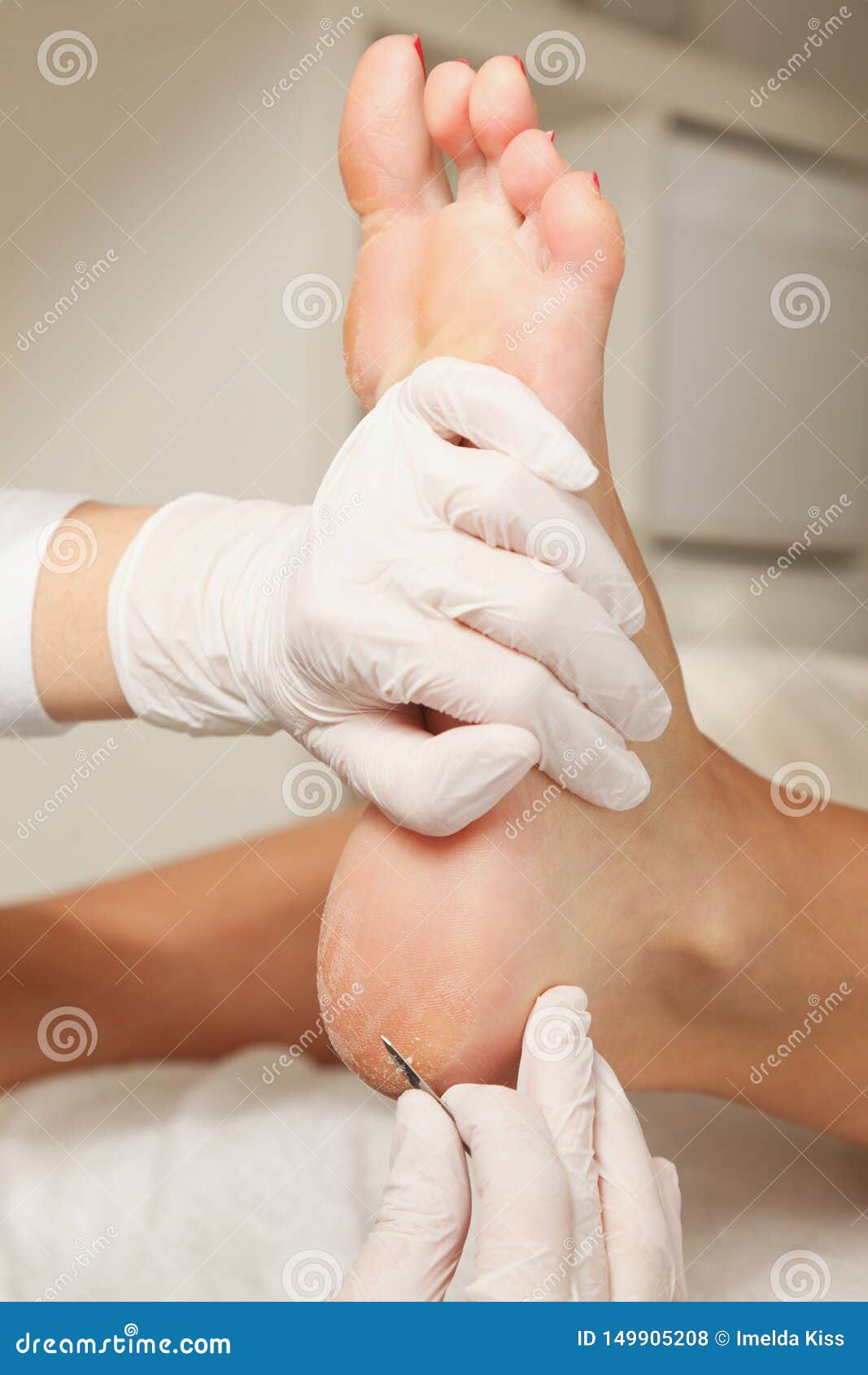 chiropodist removes skin on a wart with