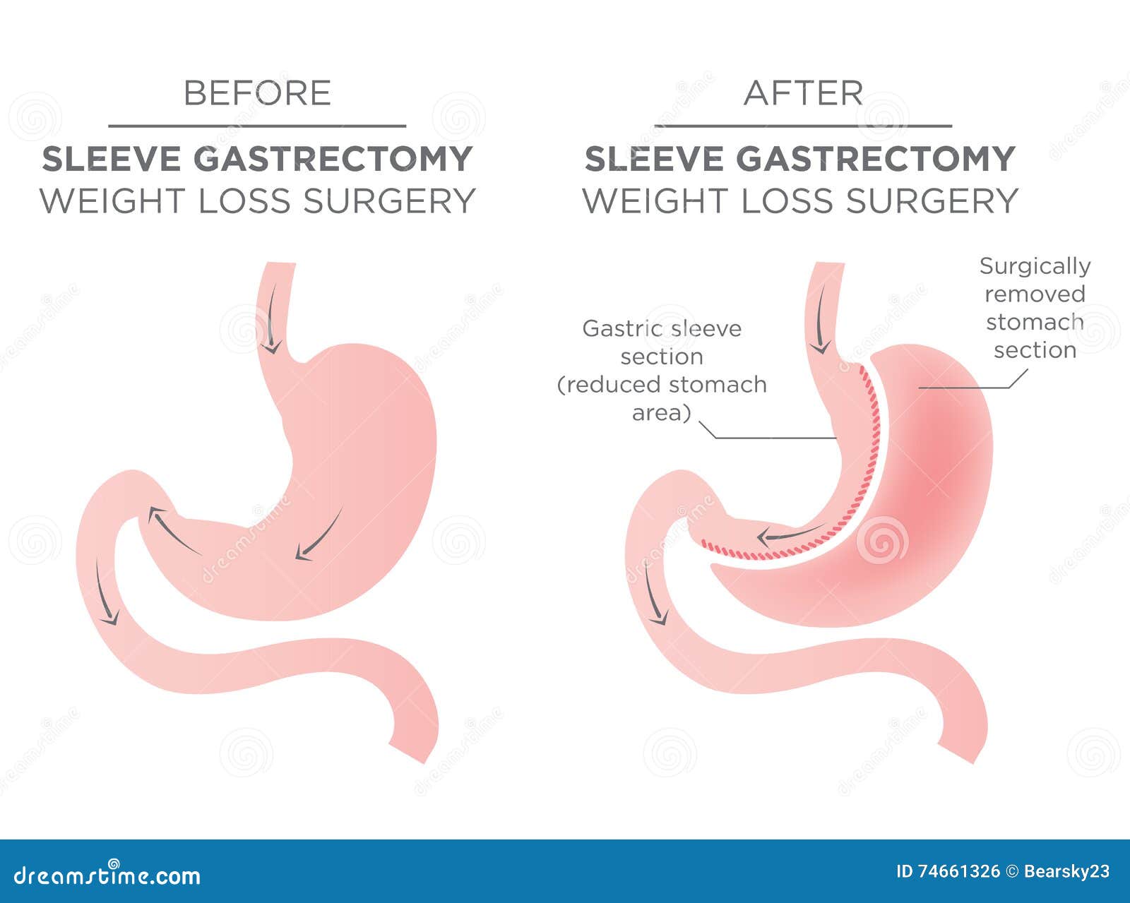 Chirurgie De Bariatric D'agrafe D'estomac Illustration de Vecteur