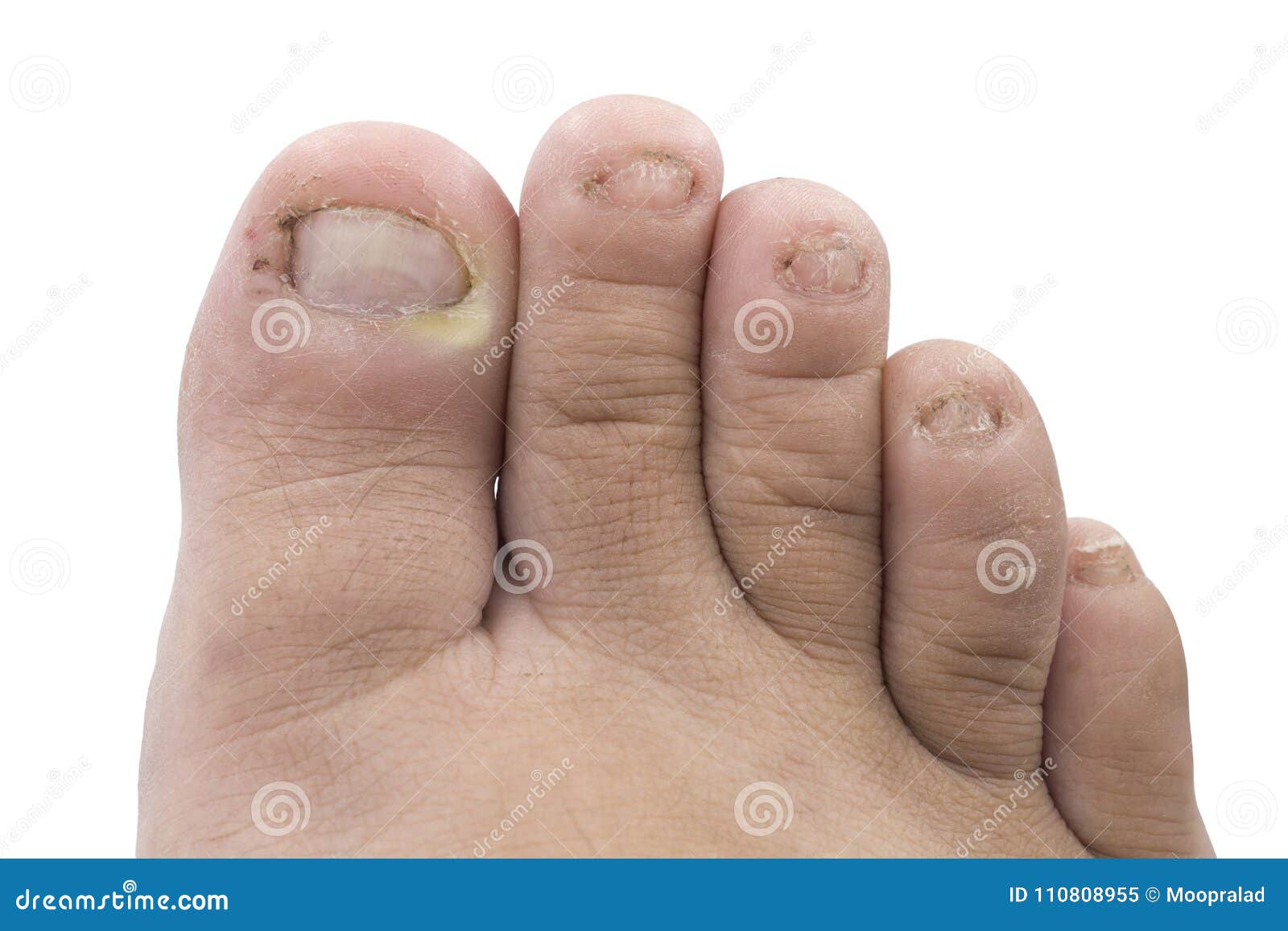 chiuda su dell infezione del fungo sulle unghie il piede dito con onychomy immagine stock immagine di medicina malattia 110808955