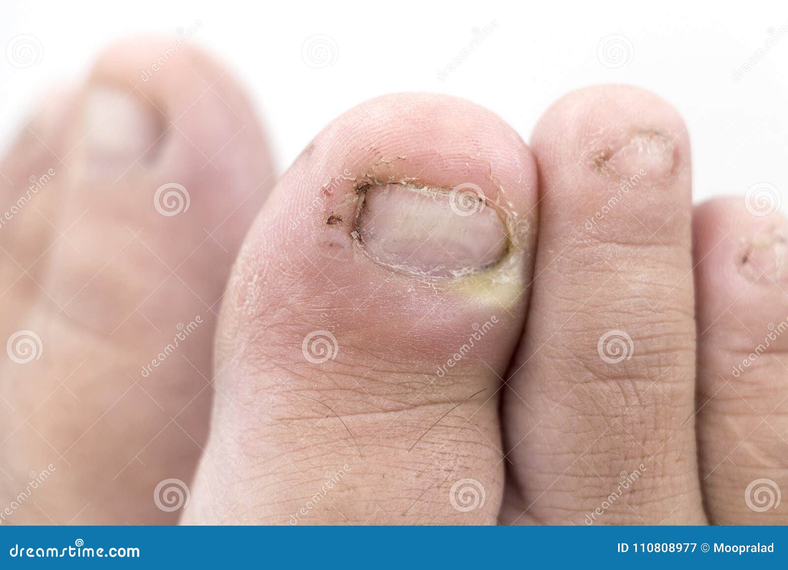 chiuda su dell infezione del fungo sulle unghie il piede dito con onychomy immagine stock immagine di medico barretta 110808977
