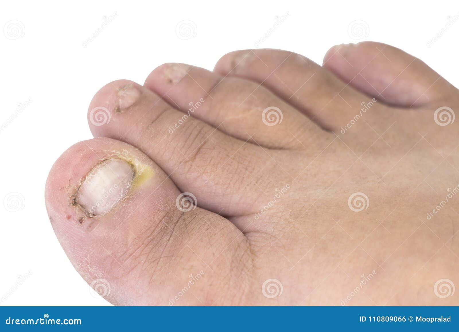 chiuda su dell infezione del fungo sulle unghie il piede dito con onychomy fotografia stock immagine di ingrossato incidente 110809066