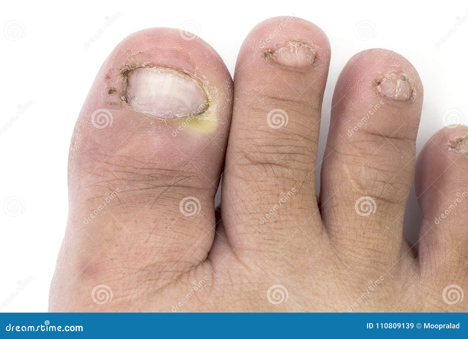 chiuda su dell infezione del fungo sulle unghie il piede dito con onychomy immagine stock immagine di podologo cura 110809139