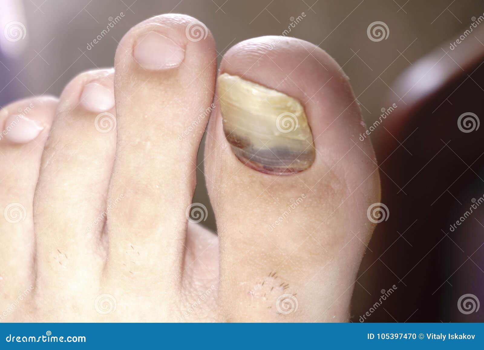 chiuda sull immagine del chiodo del dito del piede del piede destro che soffre dall infezione del fungo su fondo bianco fotografia stock immagine di nomi sofferenza 105397470