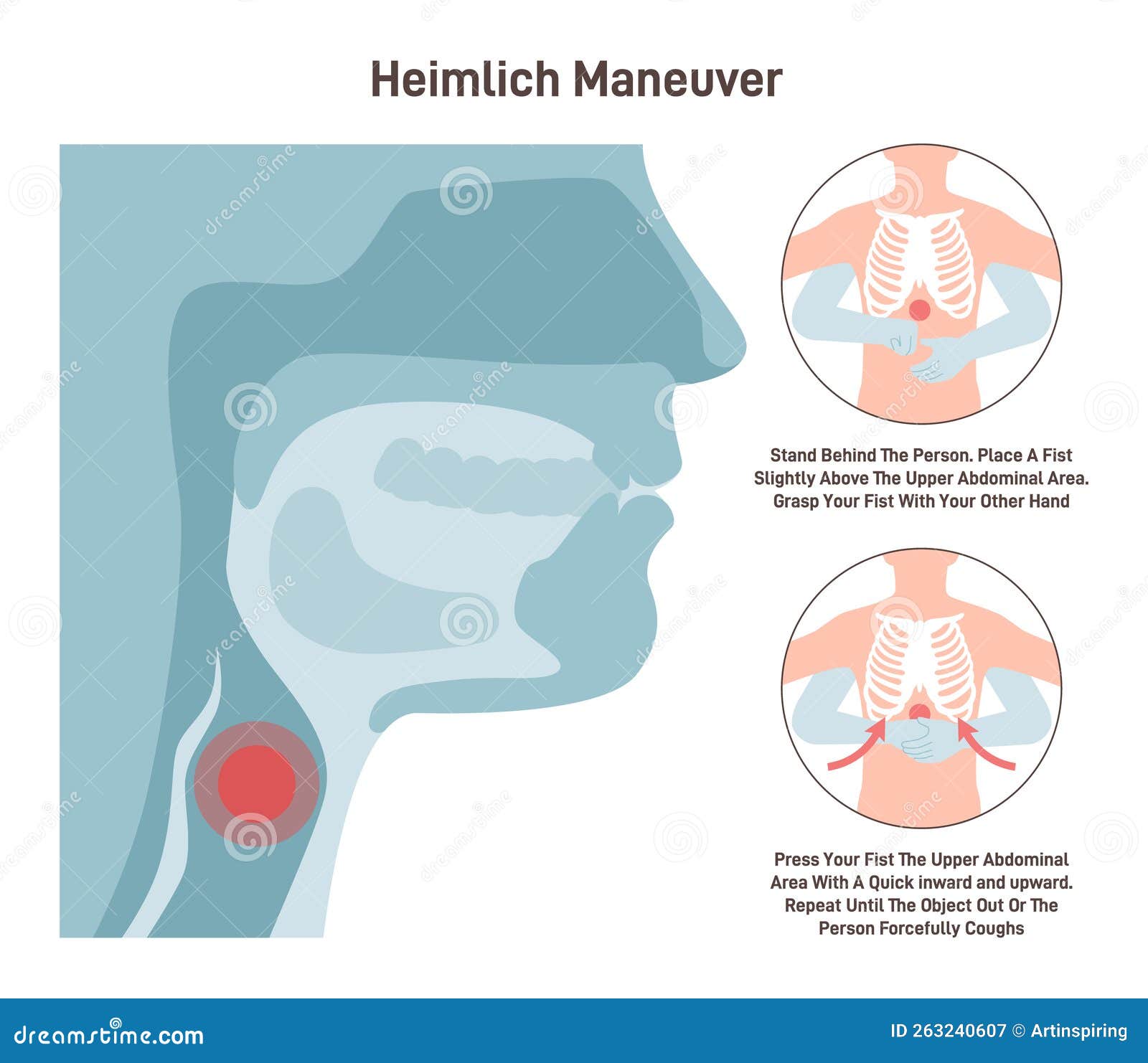 choking first aid. heimlich maneuver procedure to remove a foreign