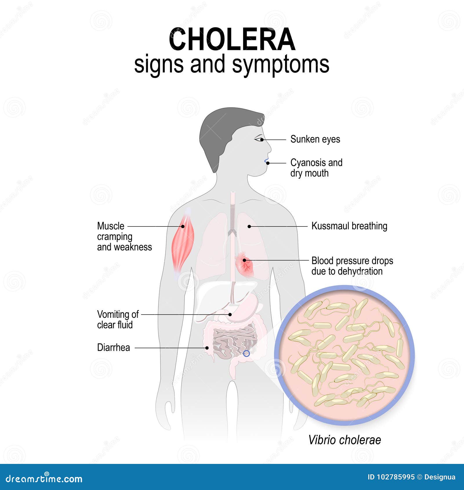 Cholera symptoms