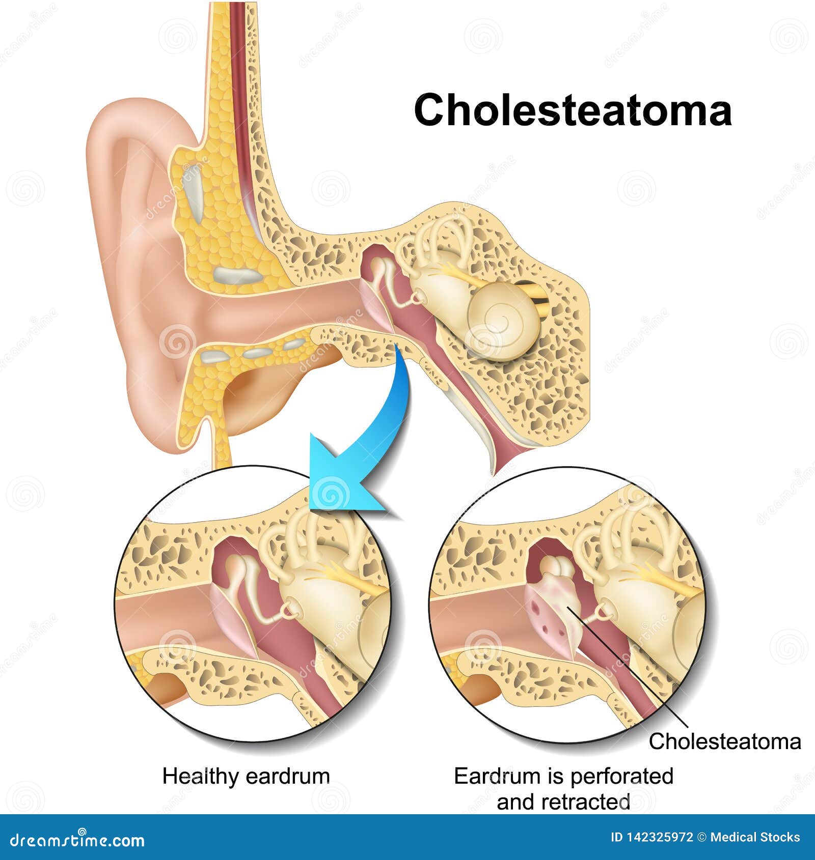 cholesteatoma human ear anatomy  illustraton on white background