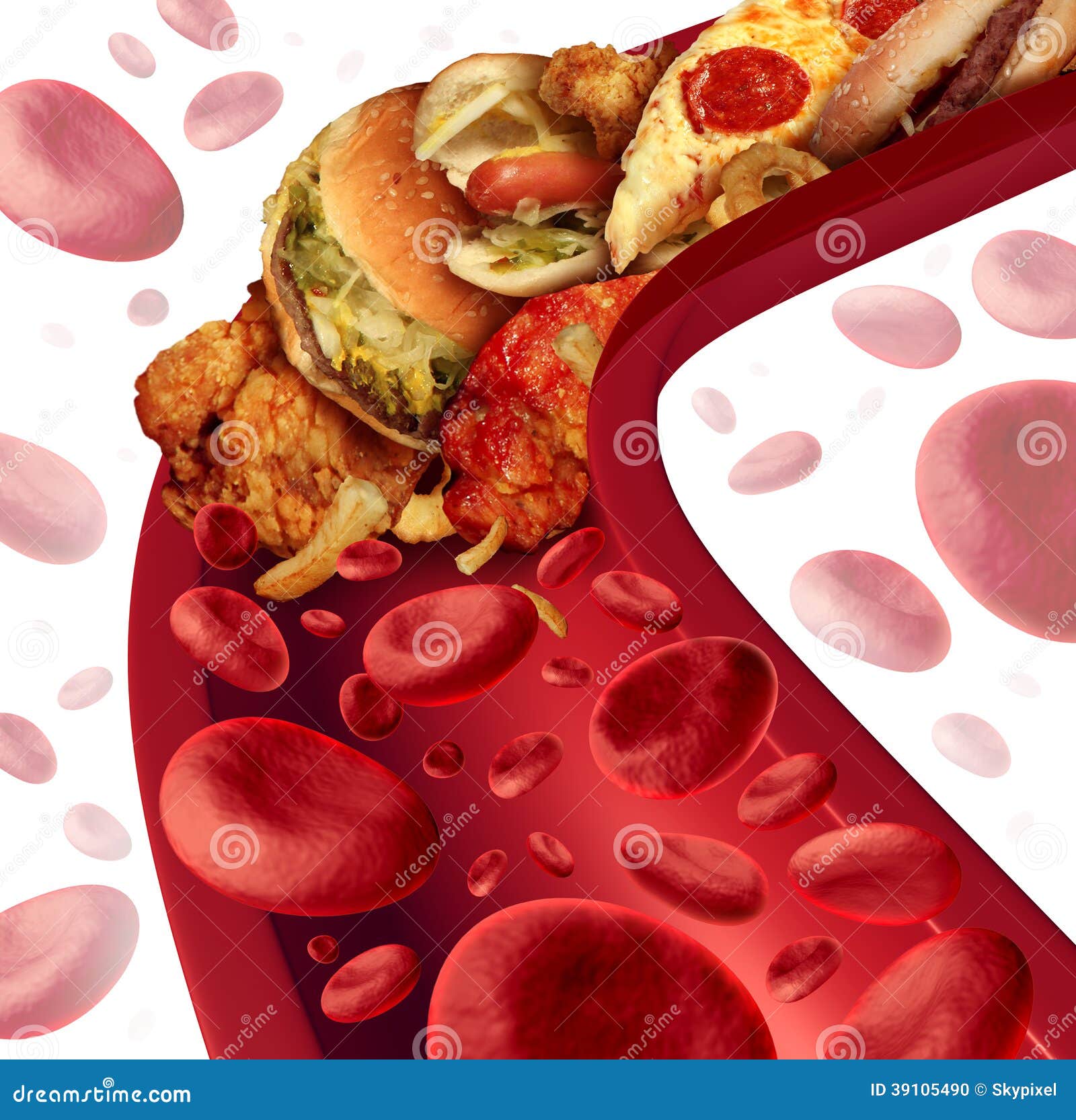 cholesterol blocked artery