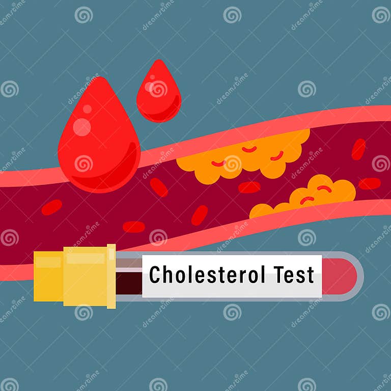 Cholesterol Blood Test. Blood Sample of Patient for Analysis of Cholesterol Test in Laboratory