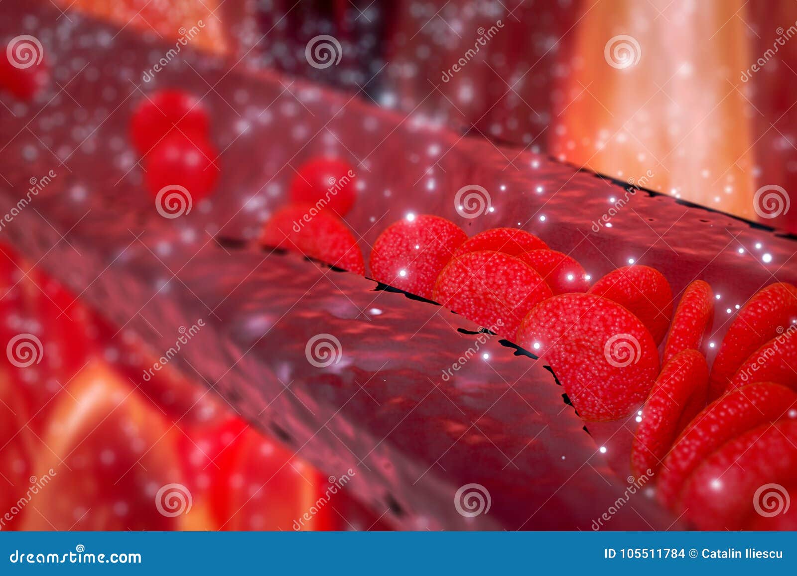 cholesterol plaque in artery, blood vessel with flowing blood cells