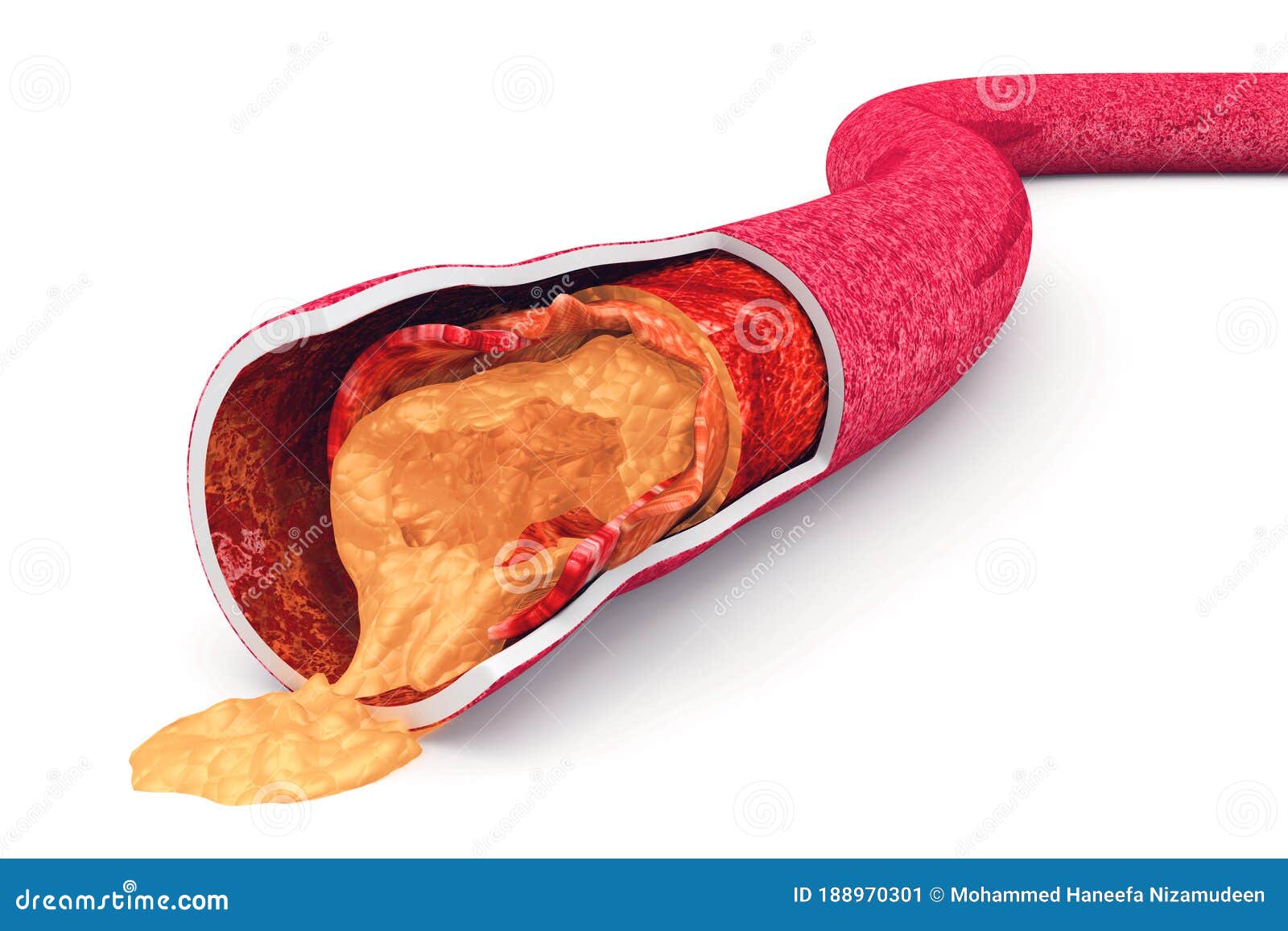 Cholesterol Plaque in Artery Stock Illustration Illustration of