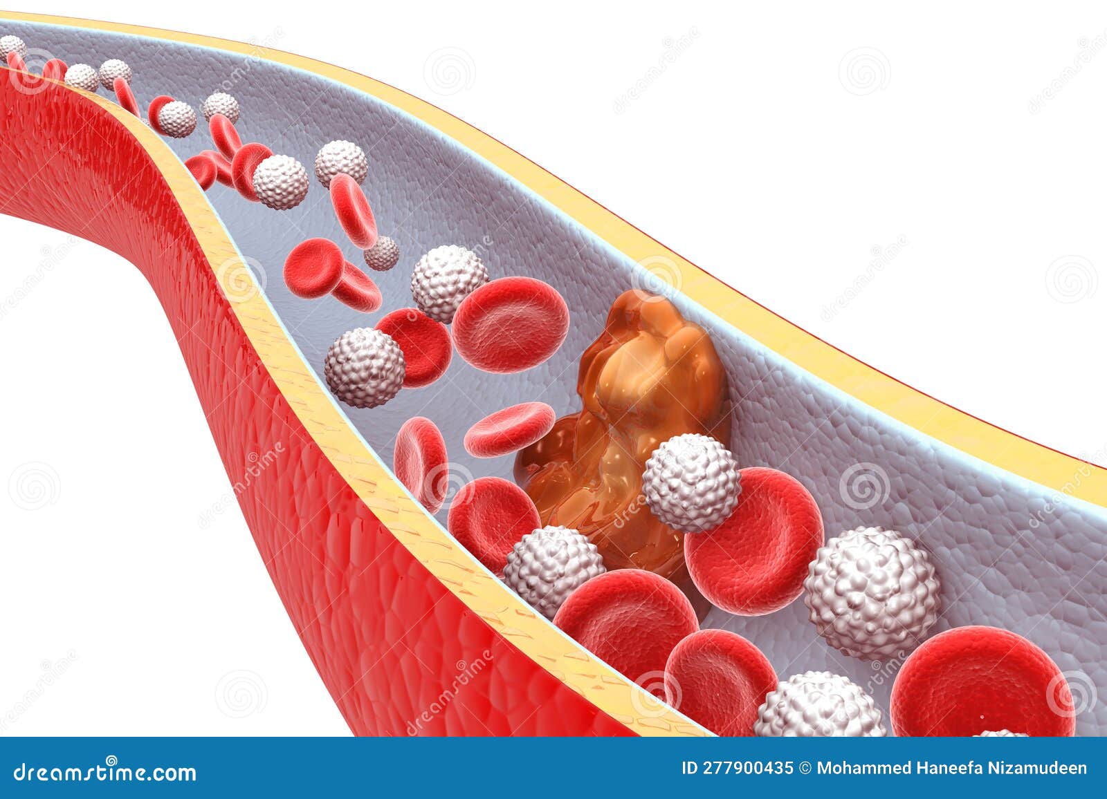 Cholesterol Plaque in Artery Stock Illustration Illustration of body, problem 277900435